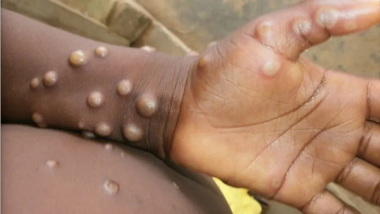 UK upgrades disease severity of monkeypox to leprosy, plague level