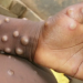 UK upgrades disease severity of monkeypox to leprosy, plague level