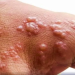 Monkeypox: Fear pushing people to dermatologists to check for symptoms