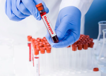 Why monkeypox can end up as large-scale global outbreak