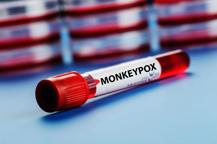 US probing 2nd possible death from monkeypox
