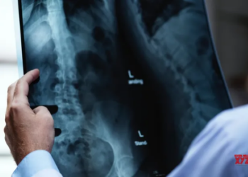 Experts discuss advances in spinal cord injury care, rehab