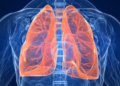 Researchers tests AI tool that predicts risk of lung cancer