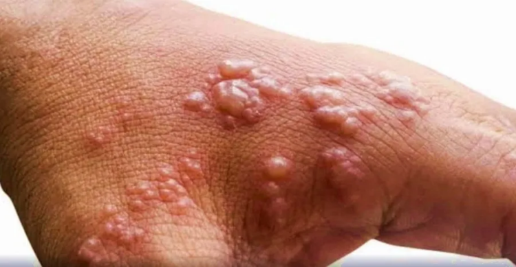 S.Korea reports 1st possible community transmission of mpox