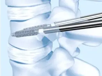 65-year-old woman undergoes vertebral body stenting in Hyderabad