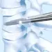 65-year-old woman undergoes vertebral body stenting in Hyderabad