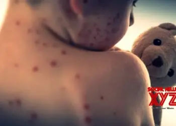 Measles cases rising alarmingly across Europe: WHO