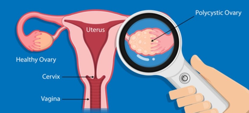 Polycystic ovary syndrome linked to memory, thinking problems