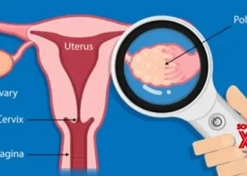 Women with PCOS more likely to have memory, thinking issues in middle age: Study