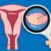 Women with PCOS more likely to have memory, thinking issues in middle age: Study